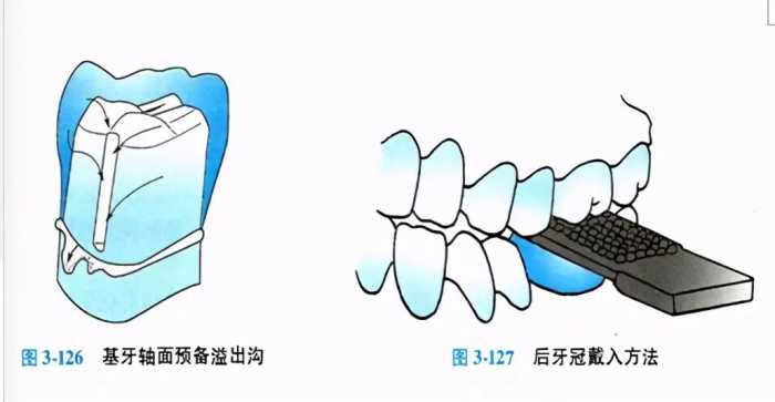 牙科医生讲义第十九讲： 牙体缺损修复体粘接、粘固与完成的流程