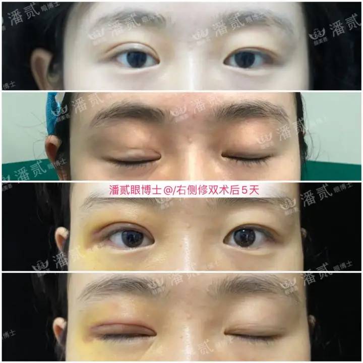 韩式微创三点双眼皮这么好，为什么竟然有医生不愿意做？