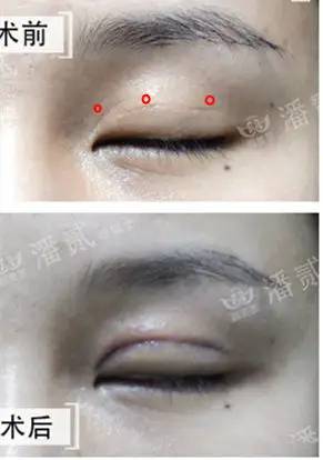 韩式微创三点双眼皮这么好，为什么竟然有医生不愿意做？